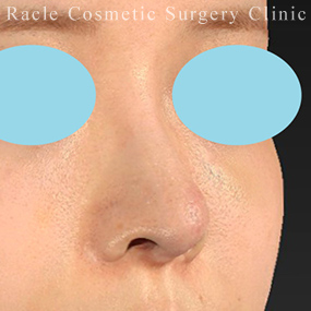鼻柱下降術の症例写真01 After