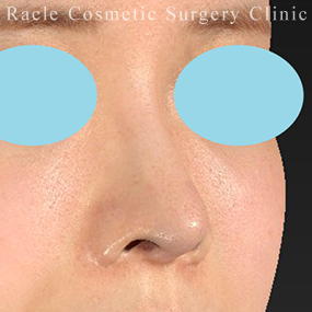 鼻柱下降術の症例写真01 Before