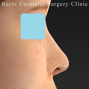 鼻柱下降術の症例写真02 After