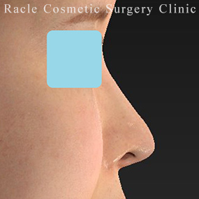 鼻柱下降術の症例写真02 Before