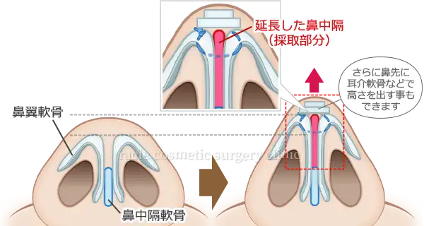 鼻中隔軟骨を延長して鼻翼軟骨先端に縫いつけ イメージ