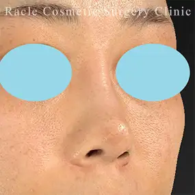 鼻中隔延長の症例写真03 Before