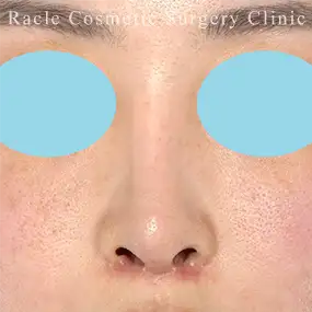 鼻中隔延長の症例写真06 Before