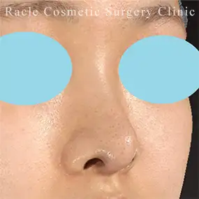 鼻中隔延長の症例写真08 After