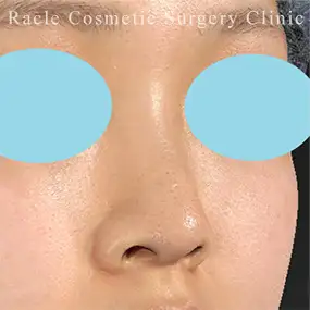 鼻中隔延長の症例写真08 Before