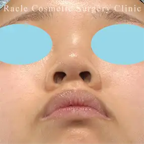 鼻中隔延長の症例写真09 Before