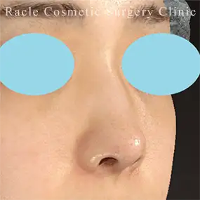 鼻中隔延長の症例写真10 After