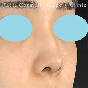 鼻中隔延長の症例写真10 Before