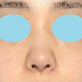 鼻中隔延長の症例写真11 After