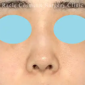鼻中隔延長の症例写真11 Before