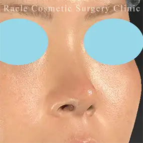 鼻中隔延長の症例写真13 Before