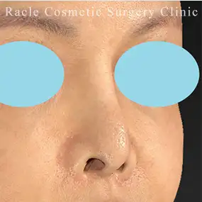 鼻中隔延長の症例写真15 Before