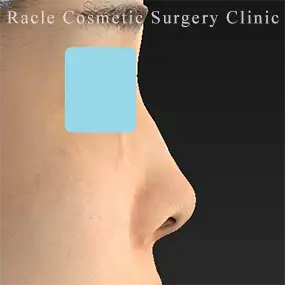 鼻中隔延長の症例写真16 Before