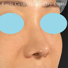 鼻中隔延長の症例写真17 After
