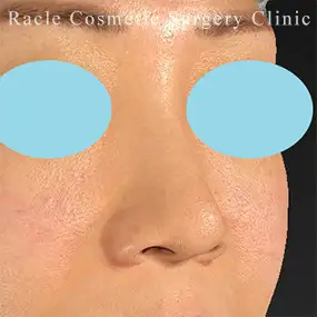 鼻中隔延長の症例写真17 Before