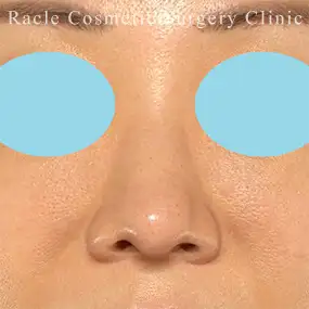鼻中隔延長の症例写真18 After