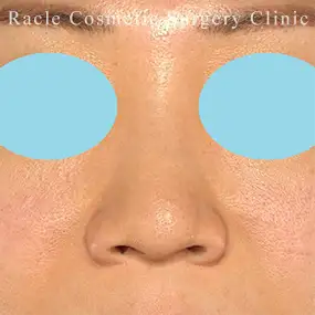 鼻中隔延長の症例写真18 Before