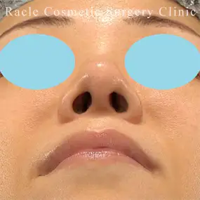 鼻中隔延長の症例写真19 After