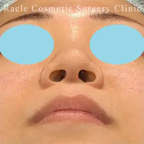 鼻中隔延長の症例写真19 Before