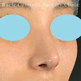 鼻中隔延長の症例写真21 After