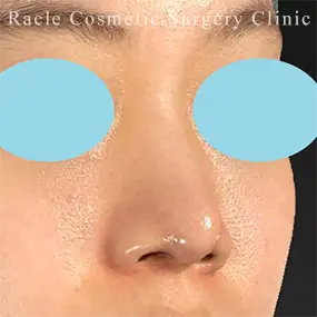 鼻中隔延長の症例写真24 After