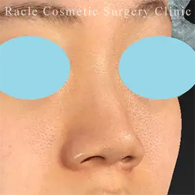 鼻中隔延長の症例写真24 Before