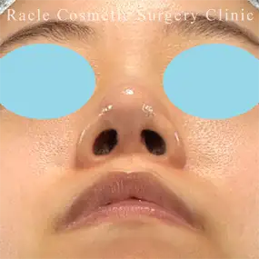 鼻中隔延長の症例写真25 After