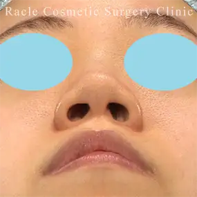 鼻中隔延長の症例写真25 Before