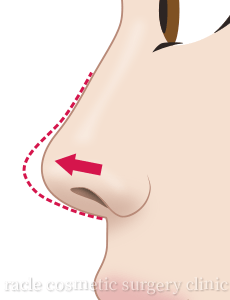鼻中隔延長 デザインイメージ01