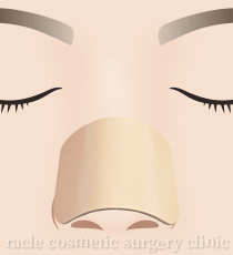 鼻中隔延長　術後の固定　イメージ
