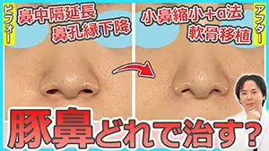 鼻中隔延長 Youtube動画03　サムネイル