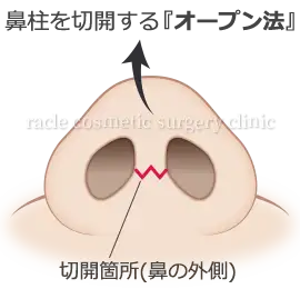 鼻中隔延長　オープン法イメージ