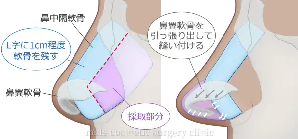 鼻中隔軟骨移植 施術イメージ