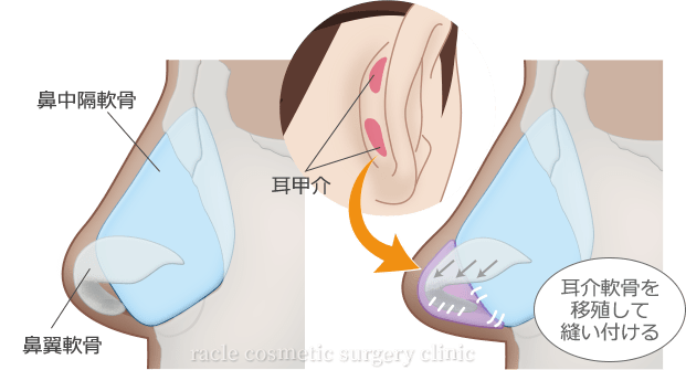 耳介軟骨移植 施術イメージ