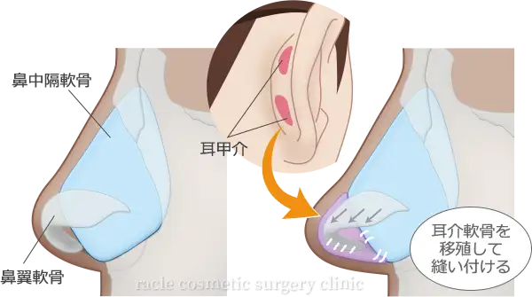 耳介軟骨移植 施術イメージ