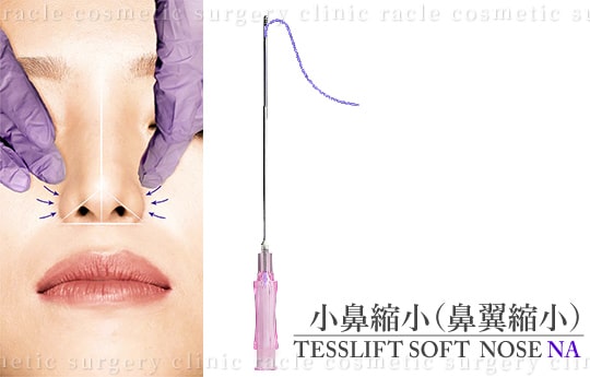 小鼻縮小(鼻翼縮小)の施術イメージ