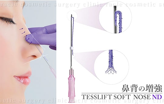 鼻背(鼻筋)の増強の施術イメージ