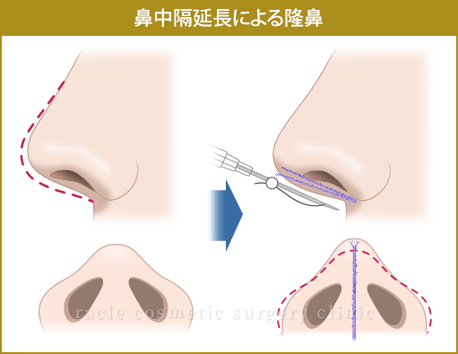鼻中隔延長による隆鼻イメージ