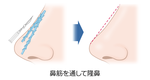 鼻筋を通して隆鼻　施術イメージ01