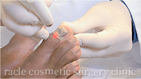 爪白癬(爪水虫)の治療イメージ1