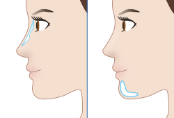 プロテーゼによる鼻・アゴの形成　イメージ