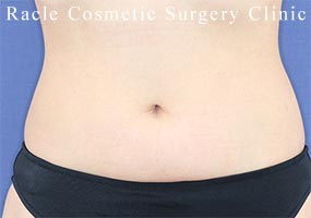 ピアスの穴開けの症例写真01 Before