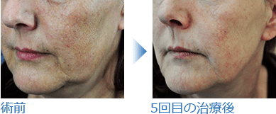 皮膚老化の5回治療後 症例写真
