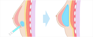 ヒアルロン酸注入豊胸(ダイヤモンドフィール KEEP 12)　施術イメージ