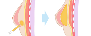 脂肪幹細胞注入豊胸　施術イメージ