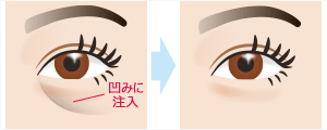 目の下の凹み(クマ) (ヒアルロン酸注入)　施術イメージ