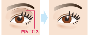 目の上の凹み(ヒアルロン酸注入)　施術イメージ