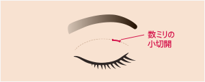 目の上の脂肪取り(マイクロカット法)　施術イメージ