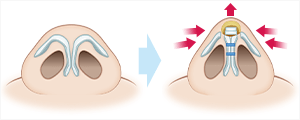 鼻尖軟骨形成(鼻尖縮小＋α法)　施術イメージ