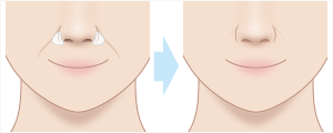 貴族手術(鼻翼基部プロテーゼ)　施術イメージ